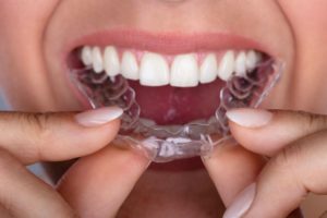 invisalign oral hygiene Irving Texas