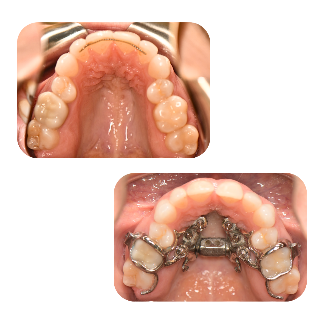 Teen Palate Scan or Expander Diagram